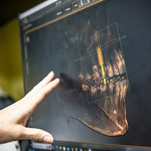 Implants | Masterpiece Smiles