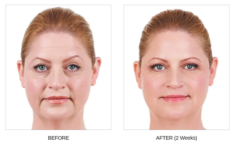 Juvederm Dermal Fillers Before and After Photos