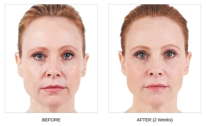 Juvederm Dermal Fillers Before and After Photos